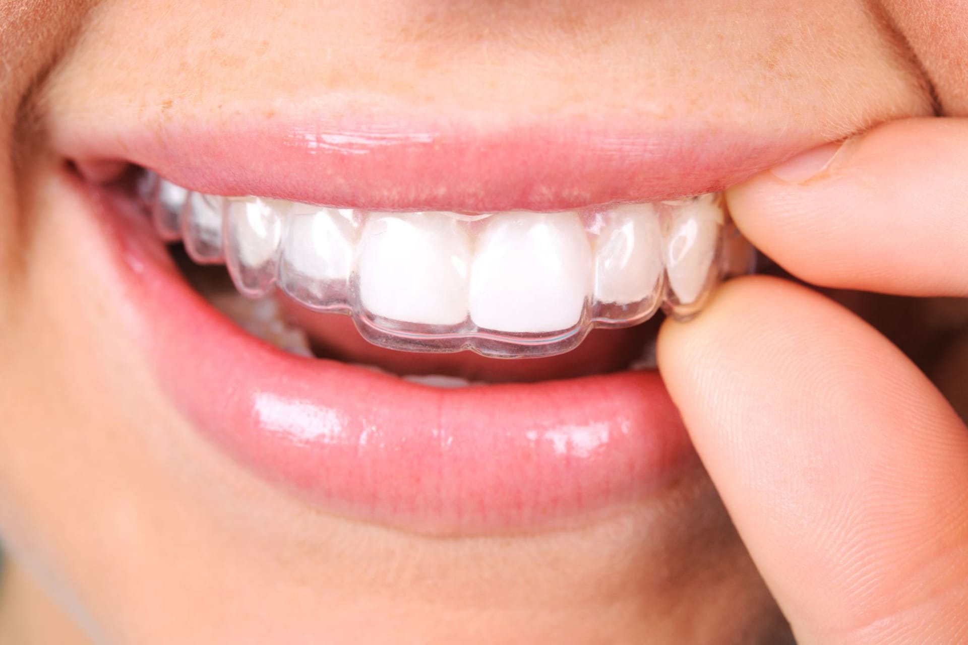 Ceramic Braces Care Tips for a Healthy and Beautiful Smile