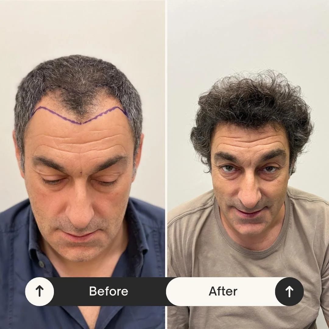 Hair Transplant UK – Achieve Thicker, Healthier Hair Today