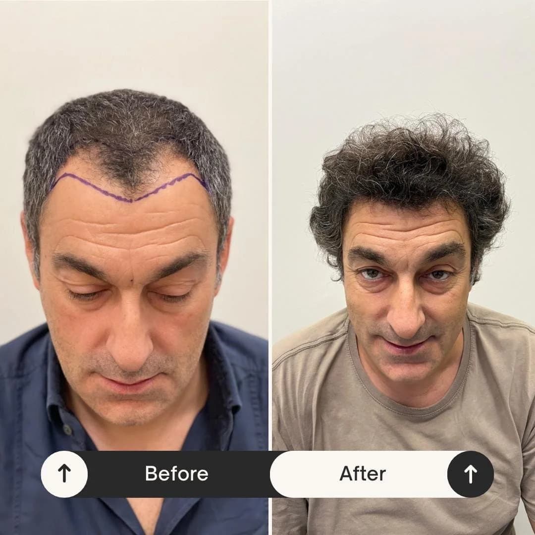 Hair Transplant UK – Achieve Thicker, Healthier Hair Today